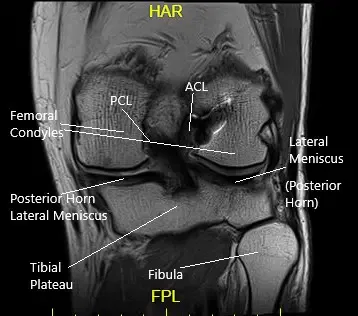 Vista de la resonancia coronal de la rodilla izquierda