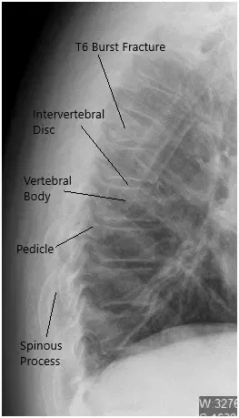 Preoperative X-ray of the Thoracolumbar Spine in Lateral View Preoperative X-ray of the Thoracolumbar Spine in Lateral View