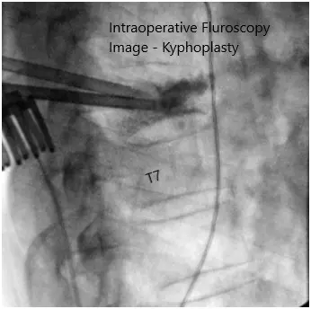 Intraoperative fluoroscopy images 2 Intraoperative fluoroscopy images 2