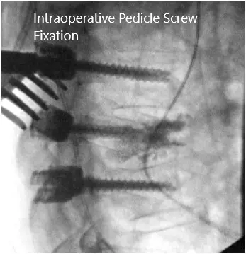 Intraoperative fluoroscopic images 3 Intraoperative fluoroscopic images 3