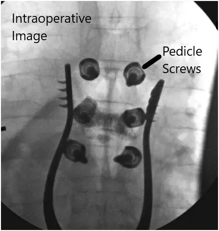 Intraoperative fluoroscopic images 4 Intraoperative fluoroscopic images 4