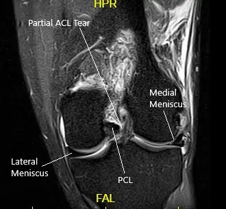 MRI of the left knee in the sagittal and coronal view 2 MRI of the left knee in the sagittal and coronal view 2
