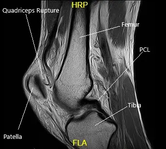 MRI of the Left Knee in the sagittal section MRI of the Left Knee in the sagittal section