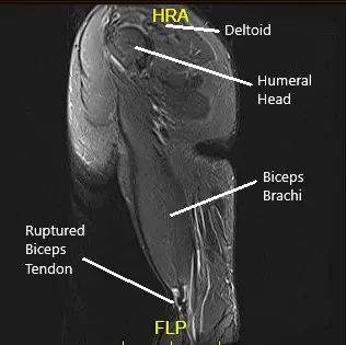 MRI showing the bicep tendon rupture MRI showing the bicep tendon rupture