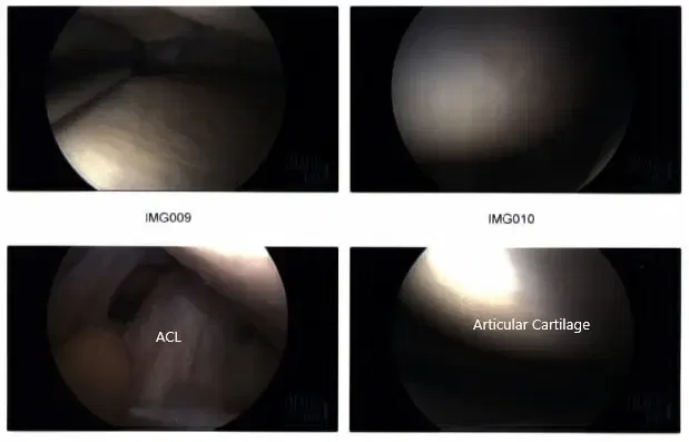 Intraoperative arthroscopic images 1 Intraoperative arthroscopic images