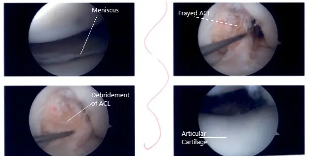Intraoperative knee arthroscopic images 3 Intraoperative knee arthroscopic images 3