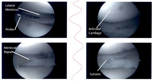 Intraoperative knee arthroscopic images 4 Intraoperative knee arthroscopic images 4