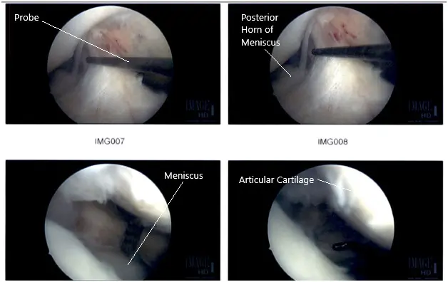 Intraoperative Arthroscopic Images of the right knee Intraoperative Arthroscopic Images of the right knee