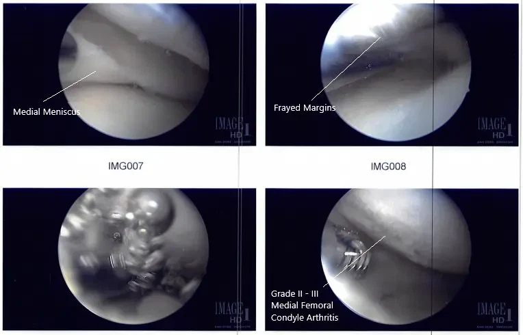 Intraoperative arthroscope images 2