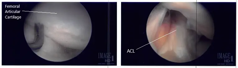 Intraoperative arthroscope images 3