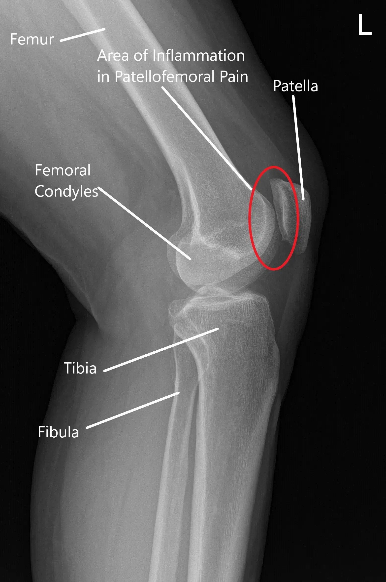 Radiografía normal de la articulación de la rodilla que muestra las distintas estructuras en la vista anteroposterior y lateral 2