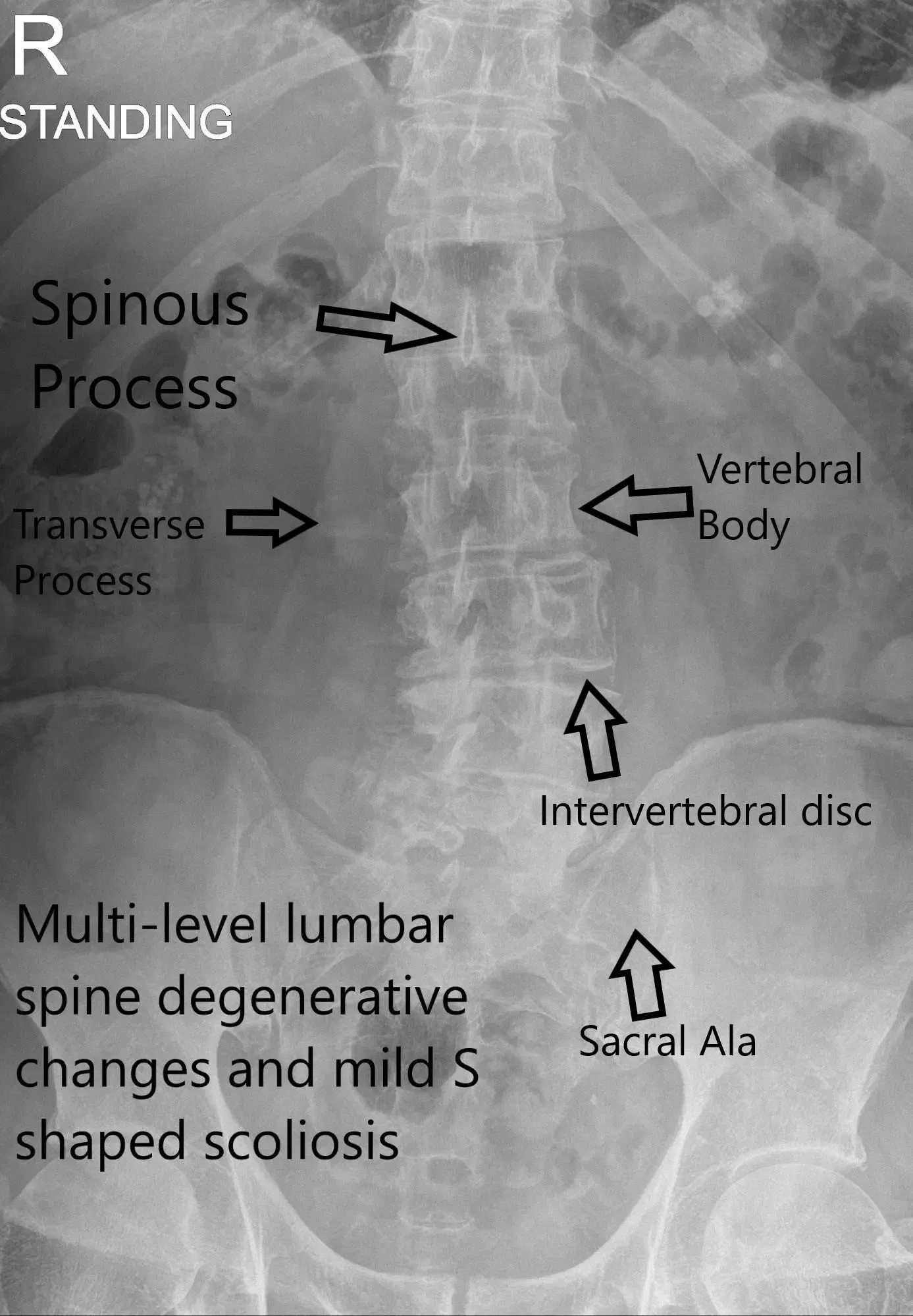 X-ray LS Spine AP view X-ray LS Spine AP view