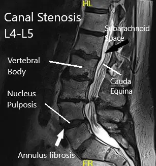 MRI of the lumbar spine MRI of the lumbar spine