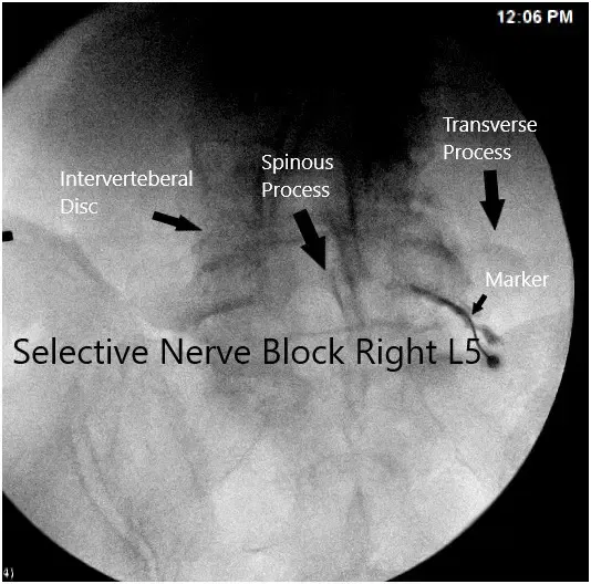 Intraoperative fluoroscopic image Intraoperative fluoroscopic image