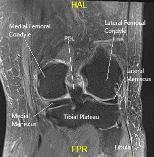 MRI of the knee in the coronal section showing various structures MRI of the knee in the coronal section showing various structures
