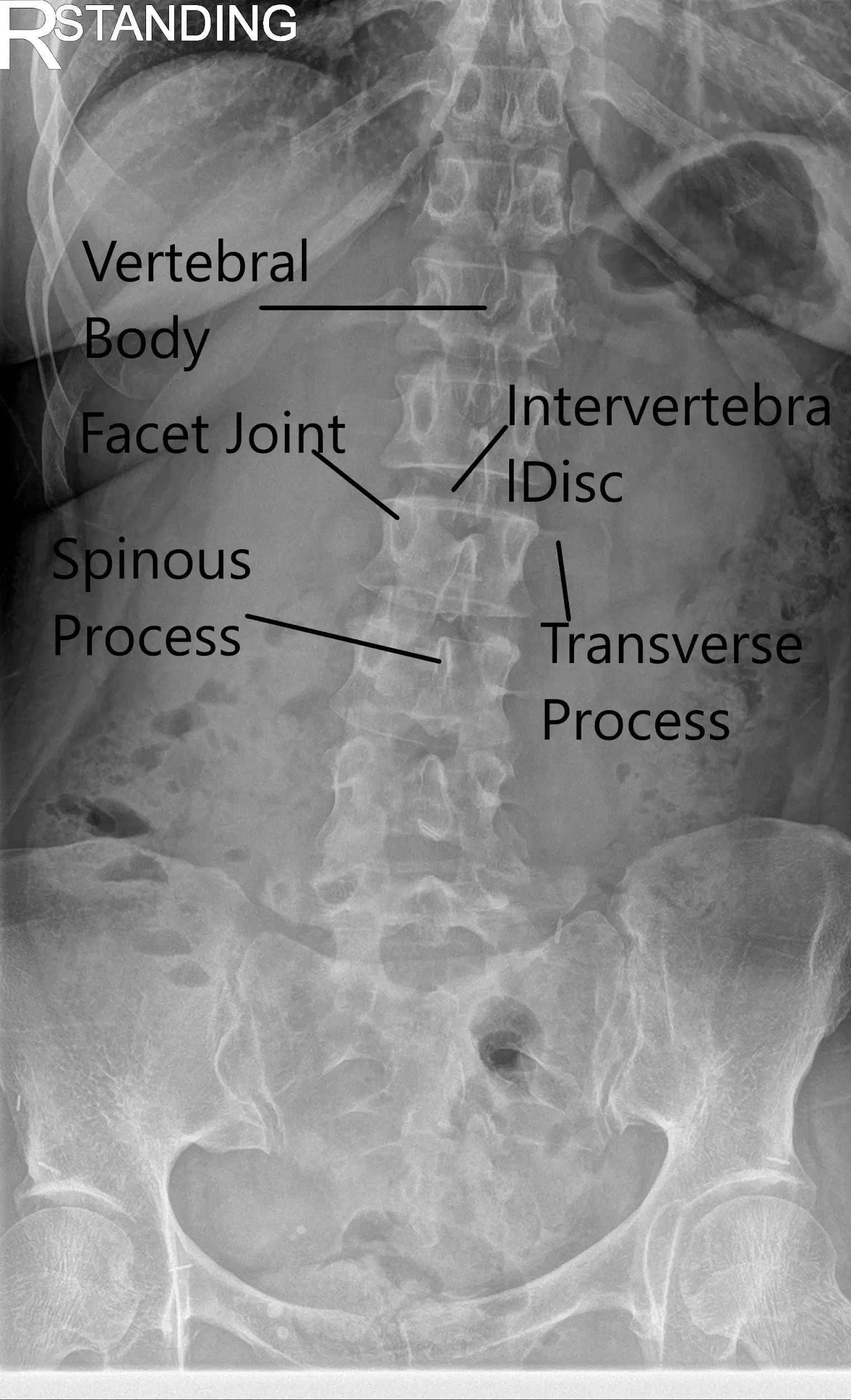 X-ray of the LS spine in AP and Lateral views showing degenerative changes 