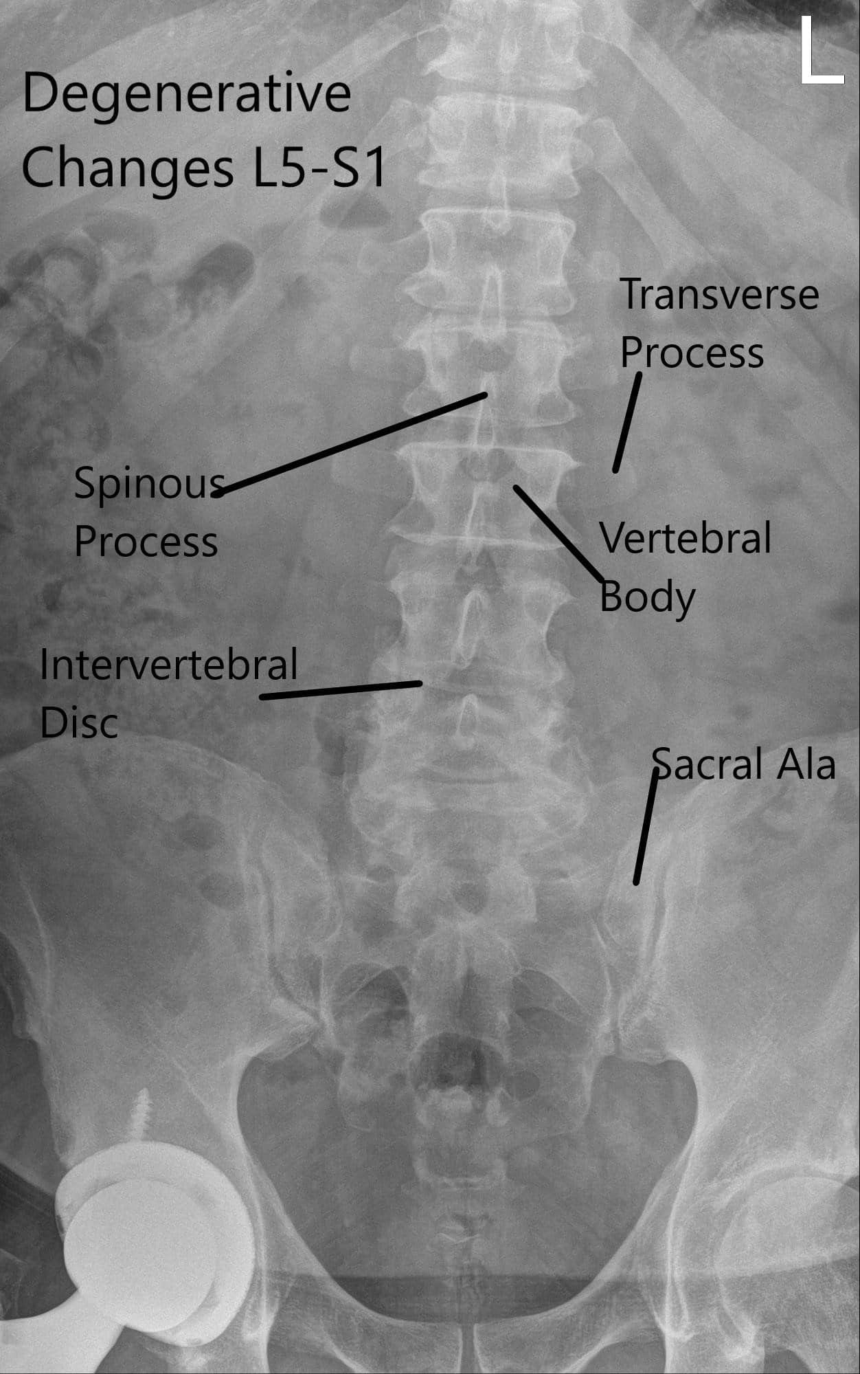Columna vertebral de la LS con radiografía preoperatoria en vistas AP y laterales