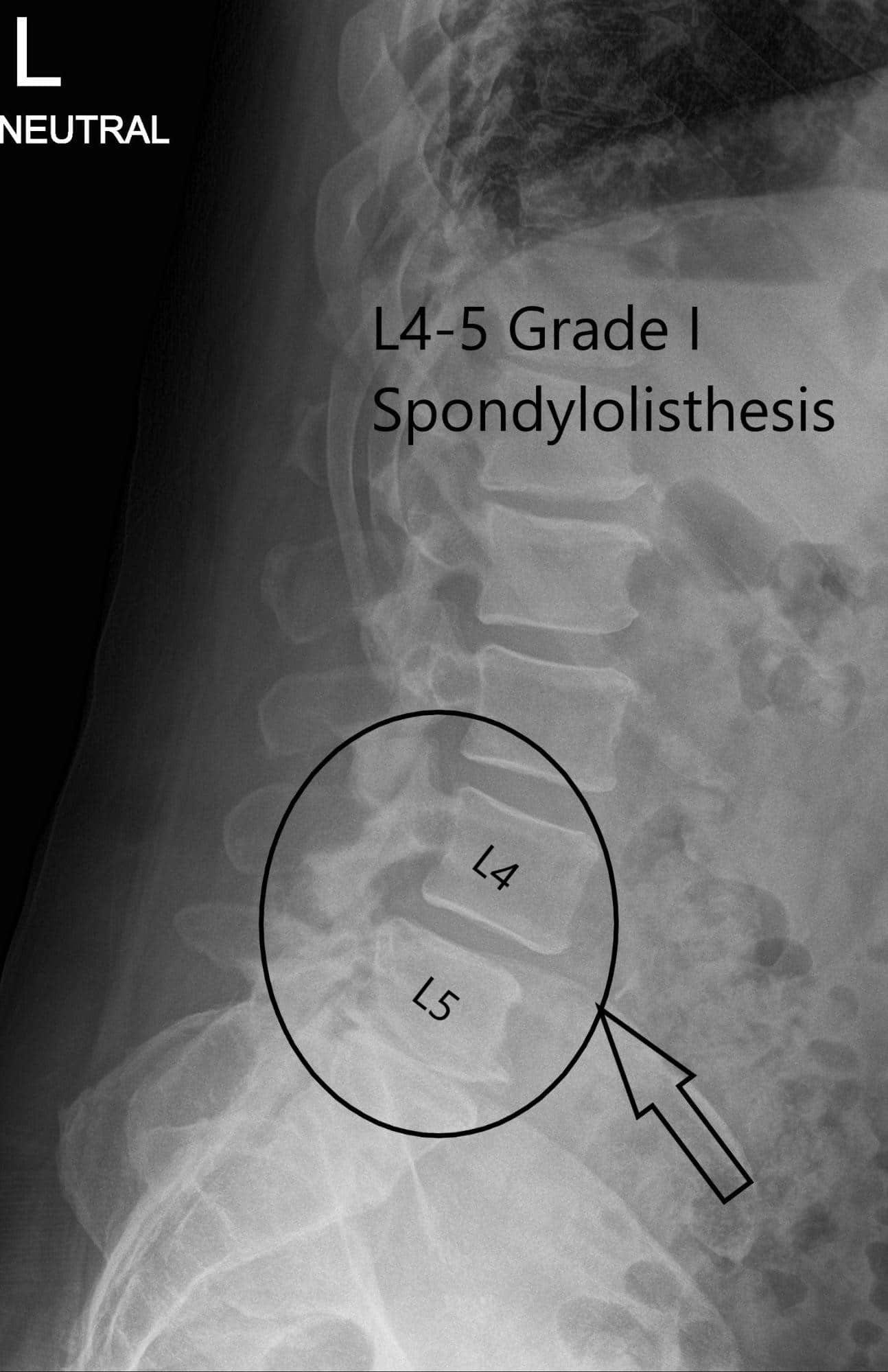 Preoperative X-ray LS spine in AP and Lateral Views 2
