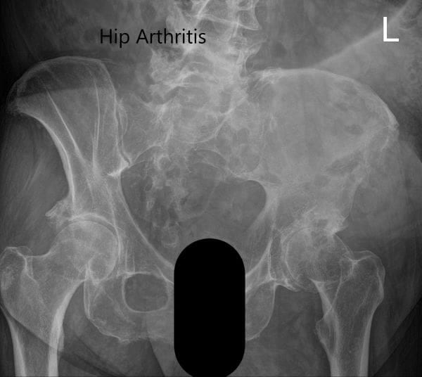 Radiografía preoperatoria que muestra la vista lateral en forma de rana y la vista AP de la cadera izquierda 2