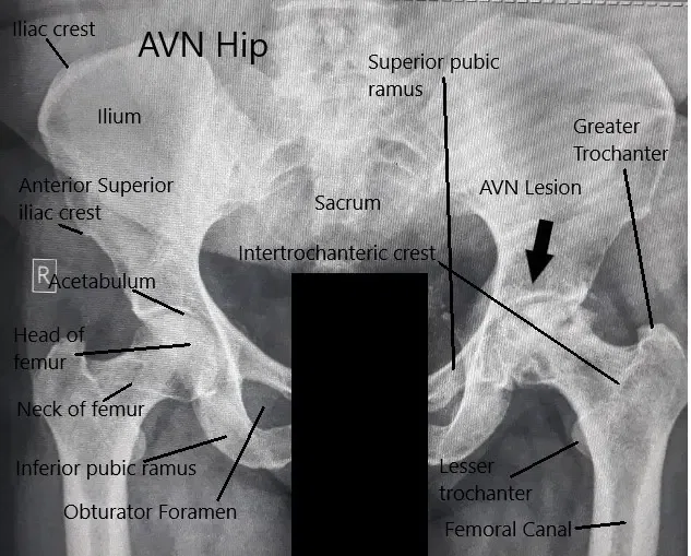 Radiografía de ambas articulaciones de la cadera que muestra el AVN de la cadera izquierda