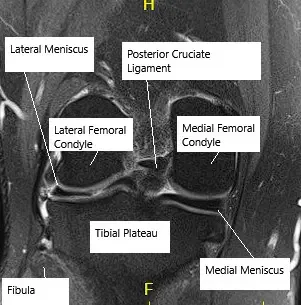 MRI showing knee meniscus.