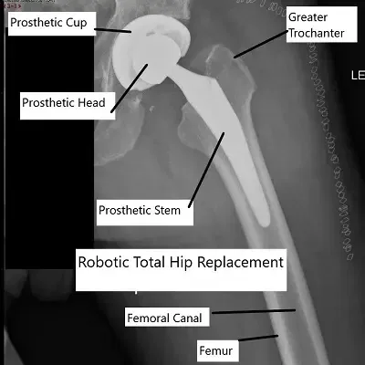Robotic Hip Replacement