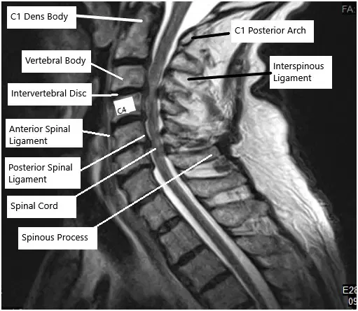 MRI of the cervical spine