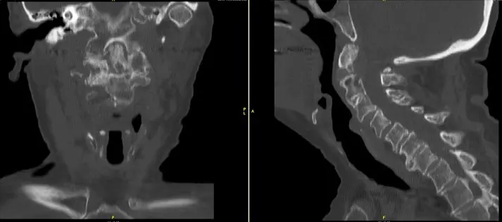Tomografía computarizada de la columna cervical que muestra la no unión del odontoide junto con cambios degenerativos de la columna cervical Tomografía computarizada de la columna cervical que muestra la no unión del odontoide junto con cambios degenerativos de la columna cervical