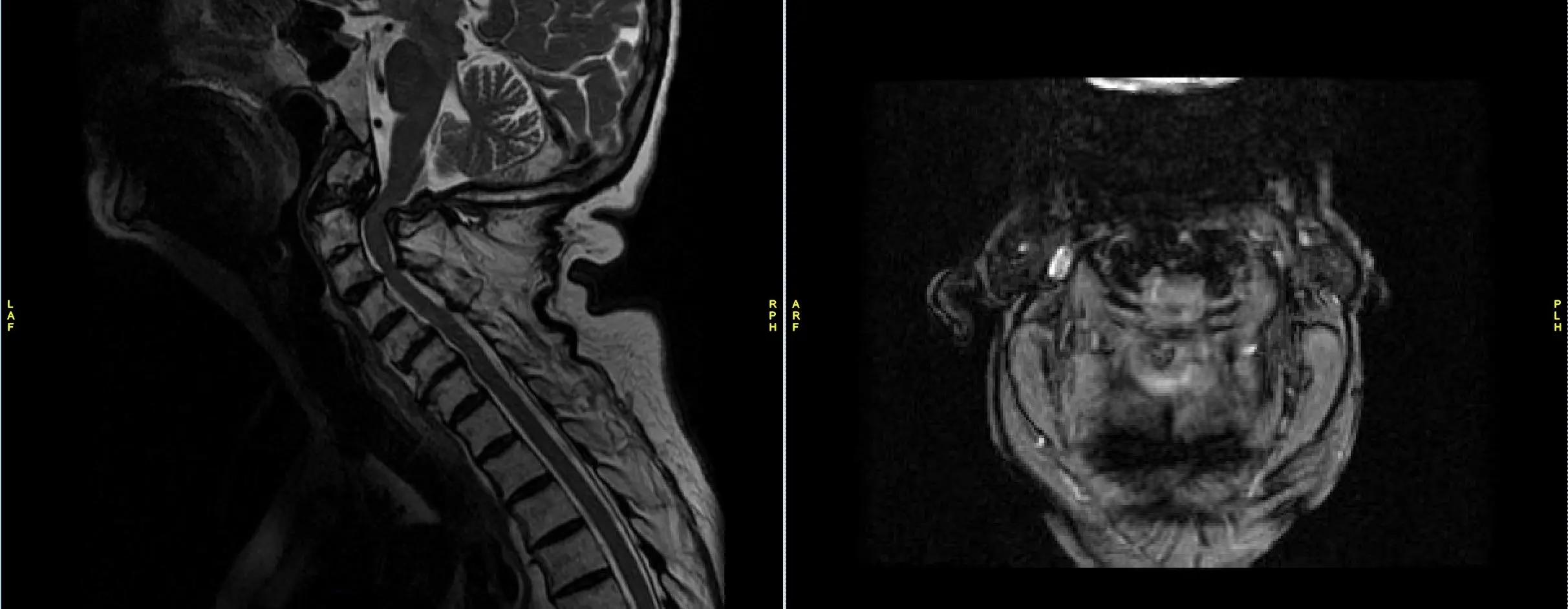 Resonancia magnética de la columna cervical que muestra estenosis crítica en C1-2 con panio fibroso posterior en la fractura odontoide Resonancia magnética de la columna cervical que muestra estenosis crítica en C1-2 con panio fibroso posterior en la fractura odontoide