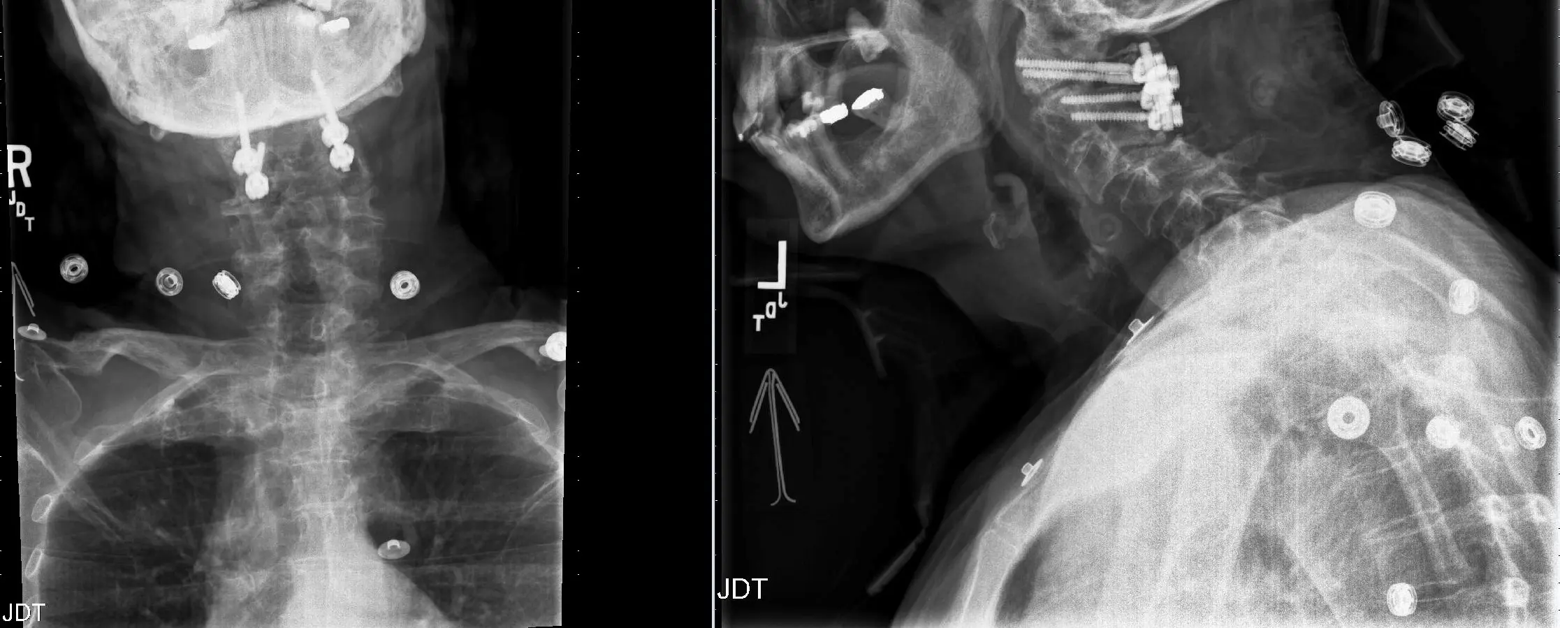 Radiografías postoperatorias tras fusión C1-2 y cirugía de descompresión Radiografías postoperatorias tras fusión C1-2 y cirugía de descompresión