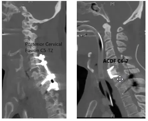 Posterior Spinal Fusion C5-T2