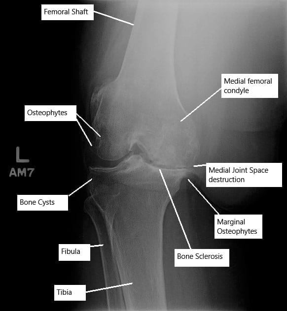 Avanzar la osteoartritis de la articulación de la rodilla izquierda en una radiografía.