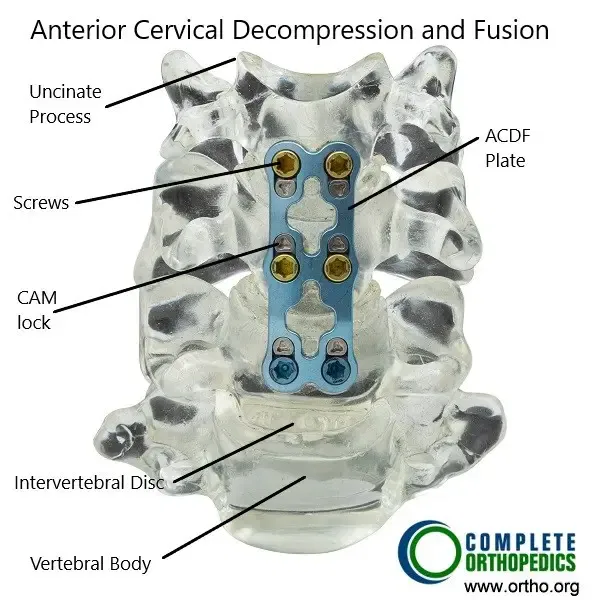 Descompresión cervical anterior y fusión