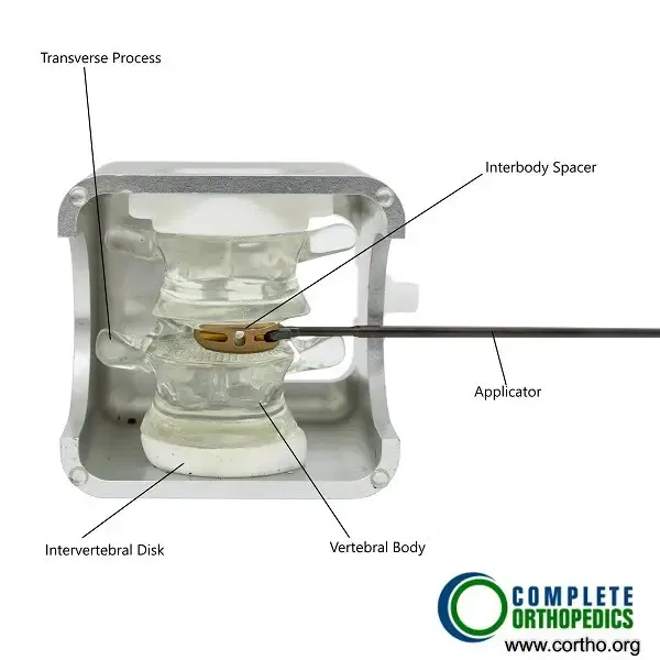 Bone Model showing XLIF.