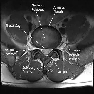 MRI of the lumbar spine in the axial section.