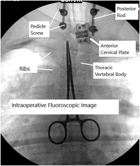 Cirugía combinada anterior y posterior de la columna cervical.