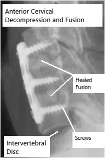 Healed and fused Anterior Cervical Decompression and Fusion.