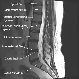 Resonancia magnética de la columna lumbar en la sección sagital que muestra la cauda equina (cola de caballo)