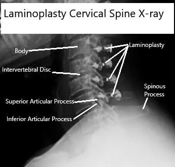 Radiografías AP y de vista lateral de la laminoplastia C3-6