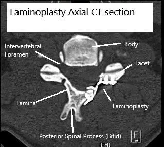 TAC axial Laminoplastia postoperatoria