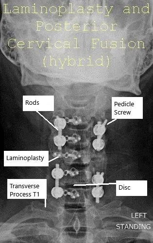 Radiografía con visión panoramática y lateral Laminoplastia postoperatoria y fusión espinal posterior