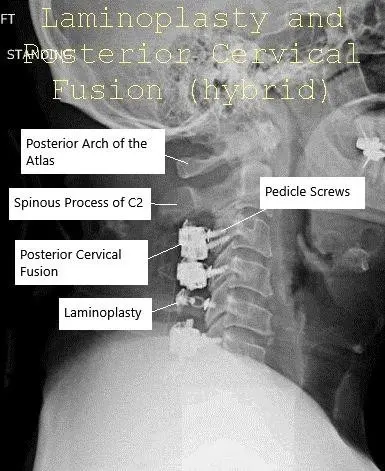 Radiografía con visión panoramática y lateral Laminoplastia postoperatoria y fusión espinal posterior
