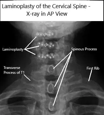AP and Lateral view X rays of Laminoplasty C3-6