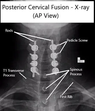 AP and Lateral View X-rays of Posterior Cervical Laminectomy and Fusion AP and Lateral View X-rays of Posterior Cervical Laminectomy and Fusion