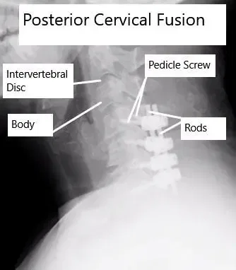 AP and Lateral View X-rays of Posterior Cervical Laminectomy and Fusion AP and Lateral View X-rays of Posterior Cervical Laminectomy and Fusion
