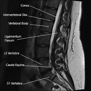 Sección sagital de la columna lumbosacra en la resonancia magnética.