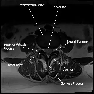 MRI axial section showing the facet joint.