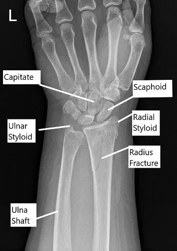 X-ray showing distal radius fracture in AP view.