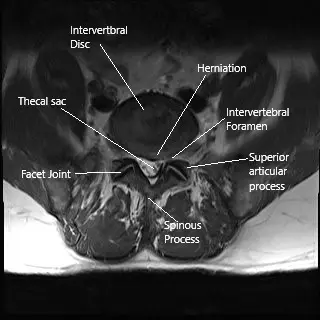 Sección axial de la columna lumbar de la resonancia magnética que muestra estenosis foraminal.