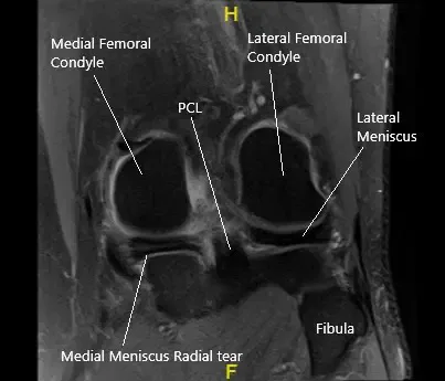 Resonancia magnética de la rodilla izquierda en la sección coronal que muestra el menisco medial desgarrado.